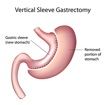 gastricsleeve