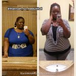 hannah weight loss surgery